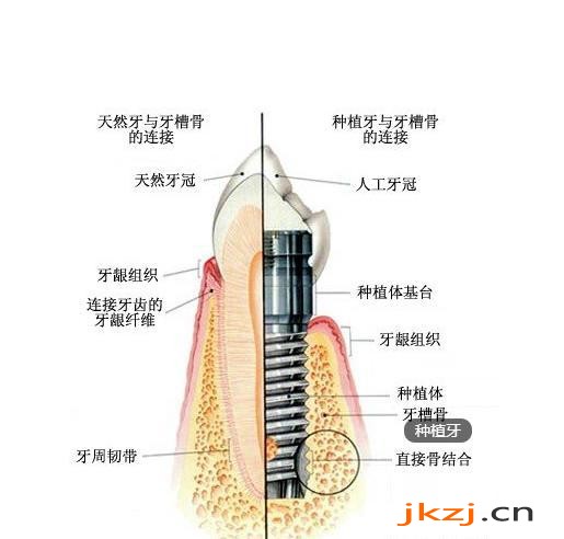 深圳做即刻种植牙修复大约多少钱？几千到几万的都有！