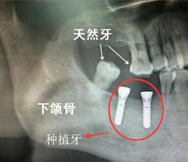 种植牙后拍片