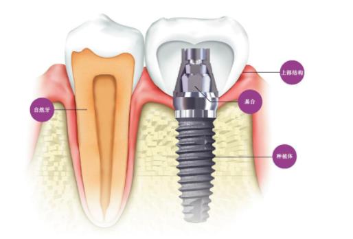 后牙种植用什么材料好