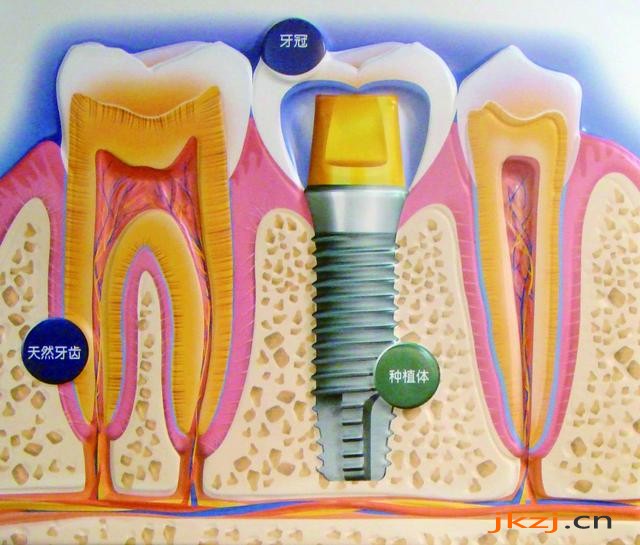 缺牙为什么种植牙？
