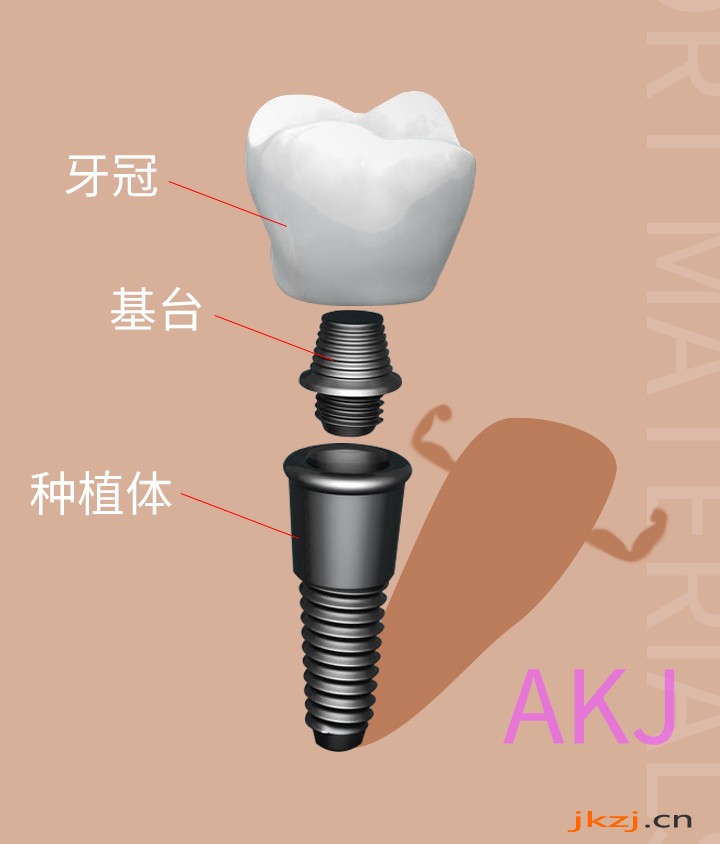 种植牙结构
