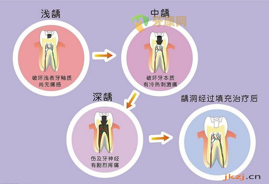 不同蛀牙