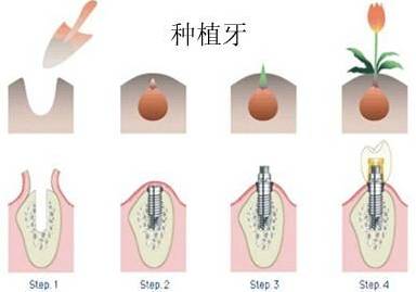 种植牙的术前检查项目有哪些