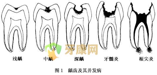 1岁宝宝奶瓶龋怎么治疗