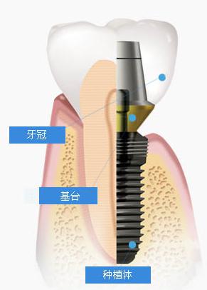 口腔种植牙治疗结果好吗