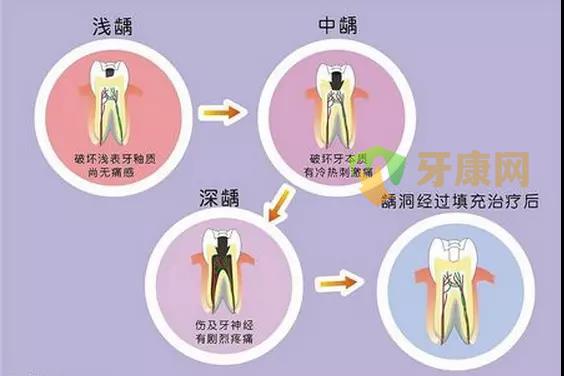 儿童乳牙龋齿要不要治疗