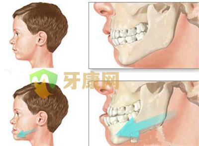 宝宝牙齿畸形矫正