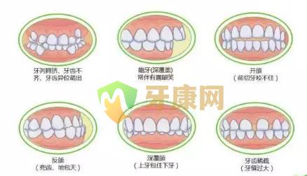 儿童错颌畸形矫正