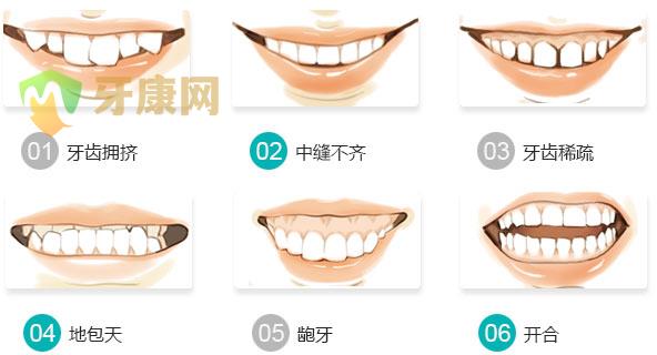 牙齿畸形需要做牙齿矫正