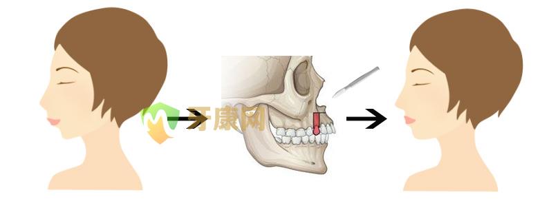 儿童牙齿不齐怎么矫正