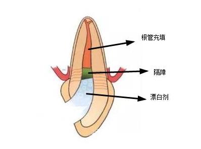 内漂白