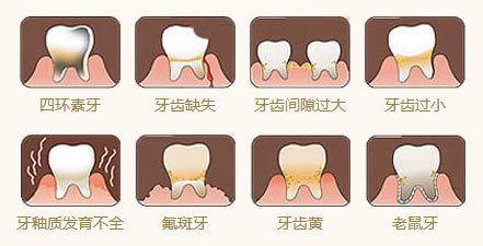 牙釉质发育不全