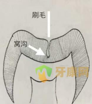 牙齿的窝沟位置