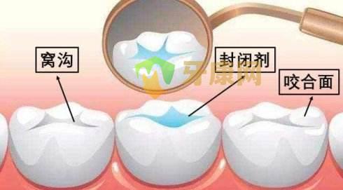 窝沟封闭