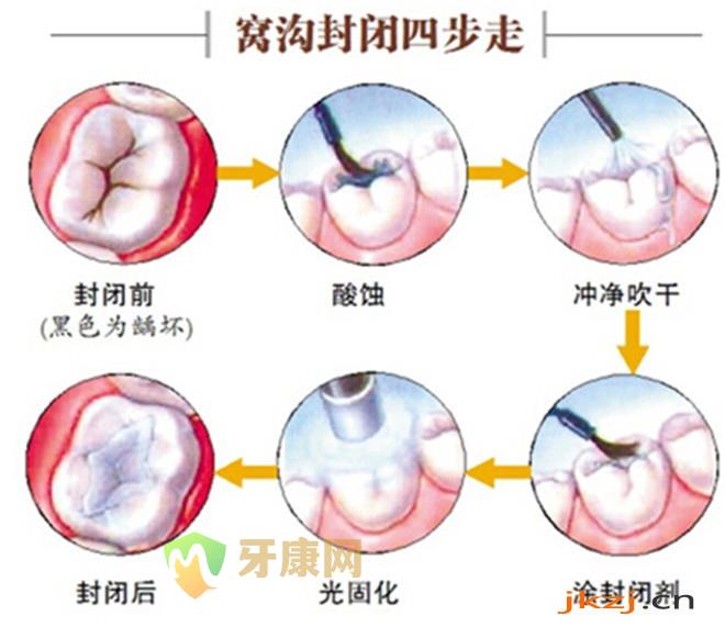 深圳医院做窝沟封闭