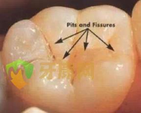 牙齿窝沟封闭