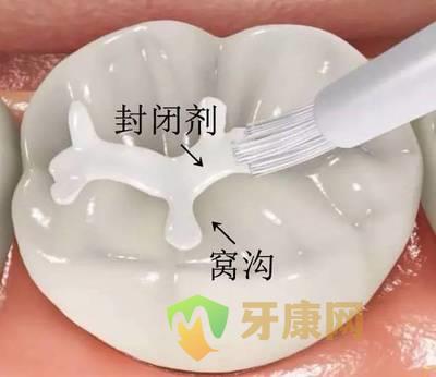 乳牙窝沟封闭的价格