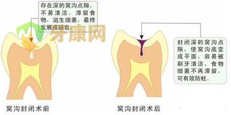 窝沟封闭