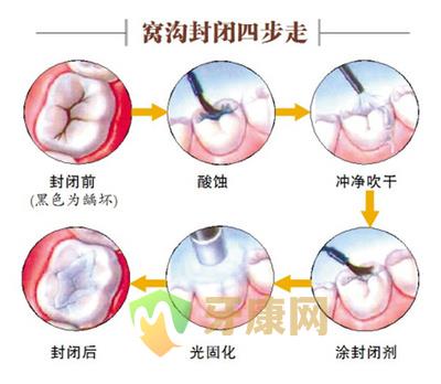 牙齿窝沟封闭的步骤