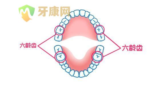 四颗六龄齿需要做窝沟封闭