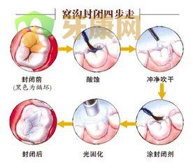 虎牙要做窝沟封闭吗