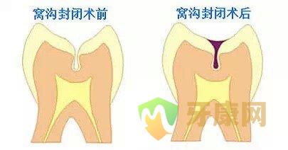 窝沟封闭的费用