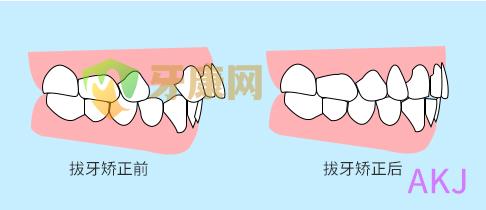 拔牙矫正