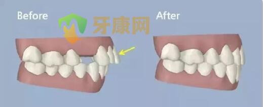 牙齿突矫正拔牙