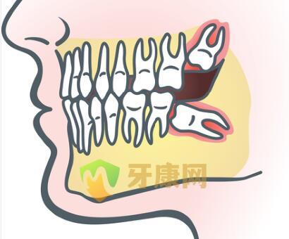 智齿对牙列产生排挤